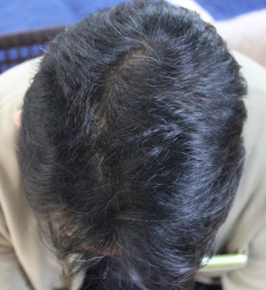 男士脱发吃什么药 治疗脱发的方式有哪些