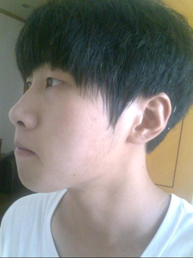 男士脱发吃什么药 治疗脱发的方式有哪些